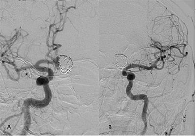 Treatment of Recurrent Wide Neck Bifurcation Aneurysm With the Barrel Vascular Reconstruction Device